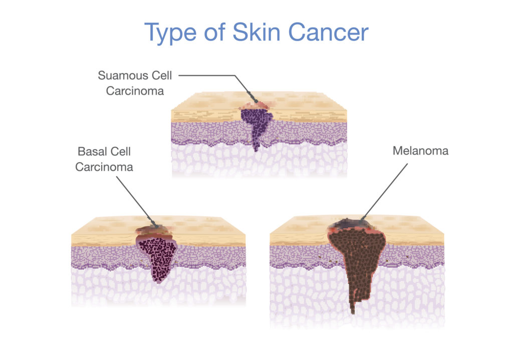 Ai can identify Types of Skin Cancer